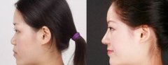 膨体隆鼻恢复的时间要多久，对比照片