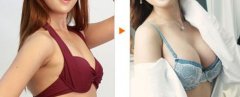假体隆胸术后多久能够穿内衣