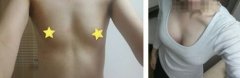 假体隆胸大概能保持多少年，是永.久的吗