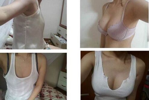 自体脂肪隆胸降低风险吗,会有后遗症吗