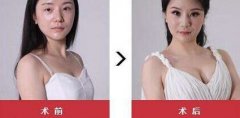 自体脂肪丰胸果到底好不好，前后对比图