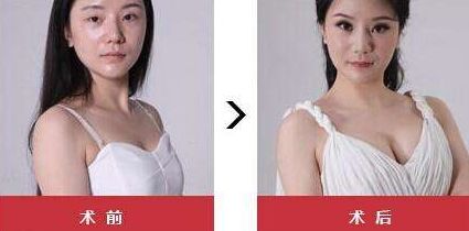 自体脂肪丰胸果到底好不好，前后对比图