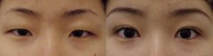全切双眼皮的恢复期是多久