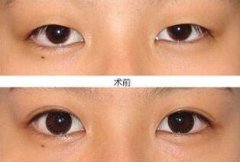 埋线双眼皮到底要不要拆线