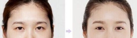 近视眼能不能做双眼皮手术