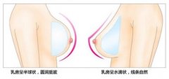 哪些人适合做假体隆胸