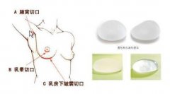 什么叫隆胸手术 什么叫隆胸手术