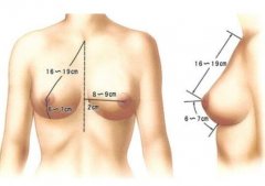 乳房太小怎么办 乳房太小怎么办