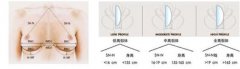 杭州假体隆胸果