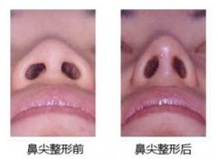 鼻尖整形手术的优点有哪些 鼻尖整形手术的优点有哪些