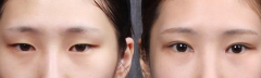 开眼角手术是怎样的？开眼角手术多少钱？