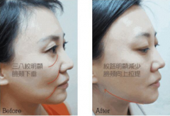 面部塌陷松弛有皱纹怎么办?埋埋提升果能管多久? 面部塌陷松弛有皱纹怎么办?埋埋提升果能管多久?