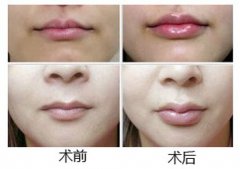 嘴唇填充、丰唇的方法有哪些?分别有哪些特点? 嘴唇填充、丰唇的方法有哪些?分别有哪些特点?