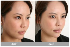 嘴唇填充的材料有哪些?它们各自的特点解析 嘴唇填充的材料有哪些?它们各自的特点解析