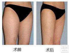 吸脂瘦大腿的果怎么样？手术会留疤吗？