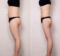 吸脂瘦大腿应该了解的事项，吸脂减肥的优势