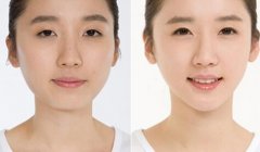 垫下巴可以改变脸型吗? 垫下巴可以改变脸型吗?