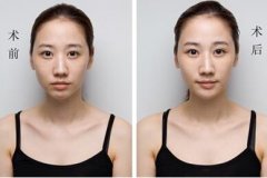 垫下巴有哪些手术方法? 垫下巴有哪些手术方法?