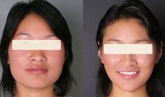 颧骨整形有哪些方法？