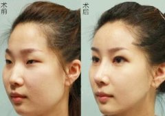 颧骨整形后应该如何护理？