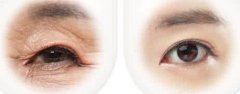 激光眼部除皱的注意事项和优势有哪些?