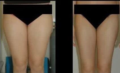 做了大腿吸脂术后多久才能洗澡