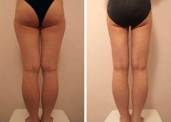 大腿吸脂和小腿吸脂有什么不同，果分别是什么
