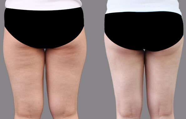 大腿吸脂减肥术后多久恢复，几天能消肿