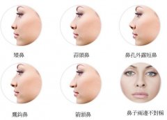 隆鼻整形前需要做什么准备工作