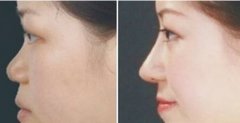 鼻部综合整形好不好，有什么优点