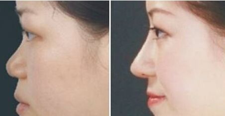 鼻部综合整形好不好，有什么优点
