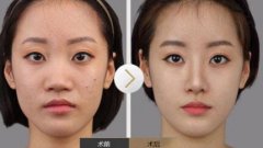鼻头太大怎么变，怎么缩小鼻头