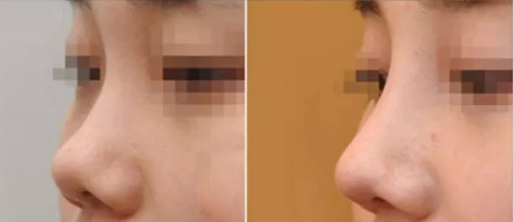 假体隆鼻术后几天能够消肿