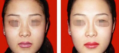 如何避免假体隆鼻术后留疤