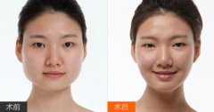 下颌角整形的风险几率大吗