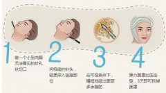 面部吸脂对解决双下巴有吗