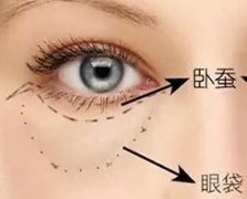 眼袋和卧蚕区别及去眼袋方法 眼袋和卧蚕区别及去眼袋方法