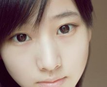 两眼距离过近开外眼角怎么样？有影响吗？