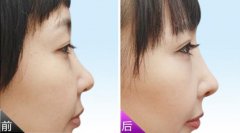 膨体隆鼻好还是硅胶好？膨体假体有哪些品牌？