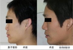 男生可以隆鼻吗？男生隆鼻好不好？男士喜欢的隆鼻方法