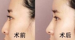 隆鼻后取出假体鼻子会变形吗? 隆鼻后取出假体鼻子会变形吗?