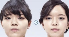 韩国颧骨颧弓降低术会导致皮肤下垂吗？