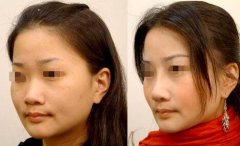 膨体隆鼻果怎么样？价格是多少？