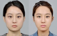 下颌角磨骨要多久才能恢复？