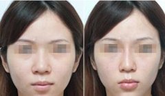 肋软骨隆鼻为什么老受推荐? 肋软骨隆鼻为什么老受推荐?