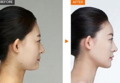 驼峰鼻整形可以直接填硅胶假体吗？