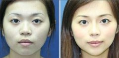 鼻翼缩小与鼻尖缩小手术有什么区别？