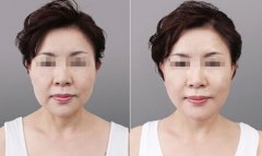 电波l皮面b提升果真的那么好吗