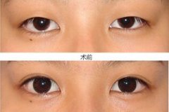 埋线双眼皮一般能够保持多少年，是永.久的吗
