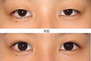 埋线双眼皮一般能够保持多少年，是永.久的吗